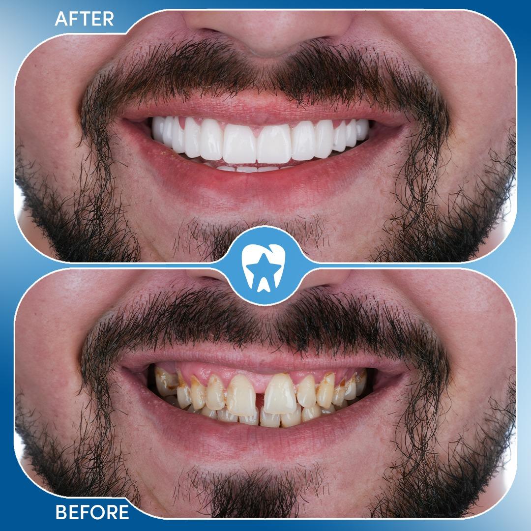 Dental Implants before and after