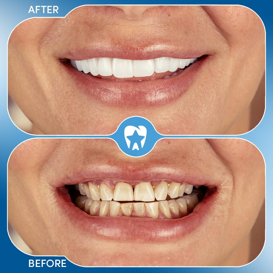 Bone Loss Implants (Zygomatic) before and after